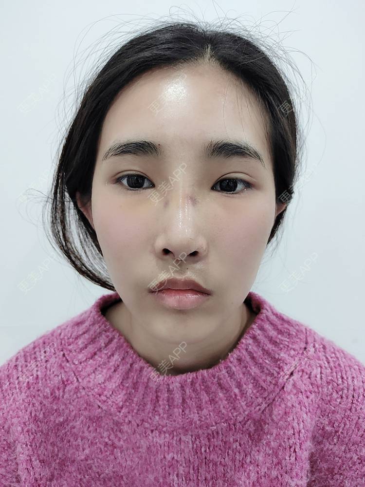 更美 - 更美用户xYVdPVYfsV的鼻部多项经验 | 鼻部多项 | 郑州