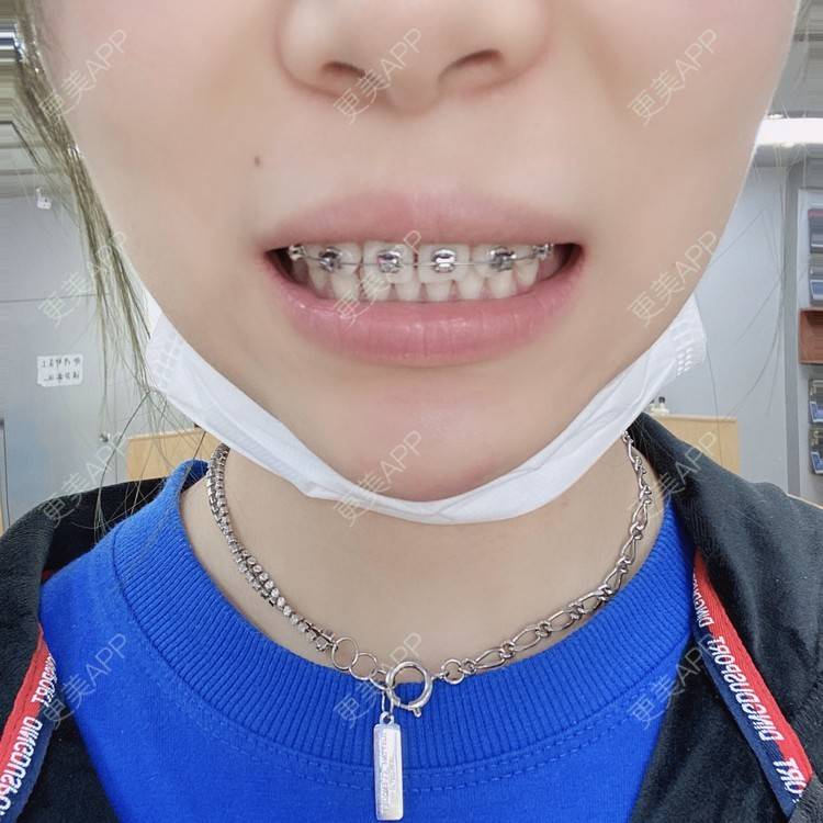 更美 - 更美用户nh0OukLNMd的牙齿矫正经验 | 牙齿矫正 | 成都