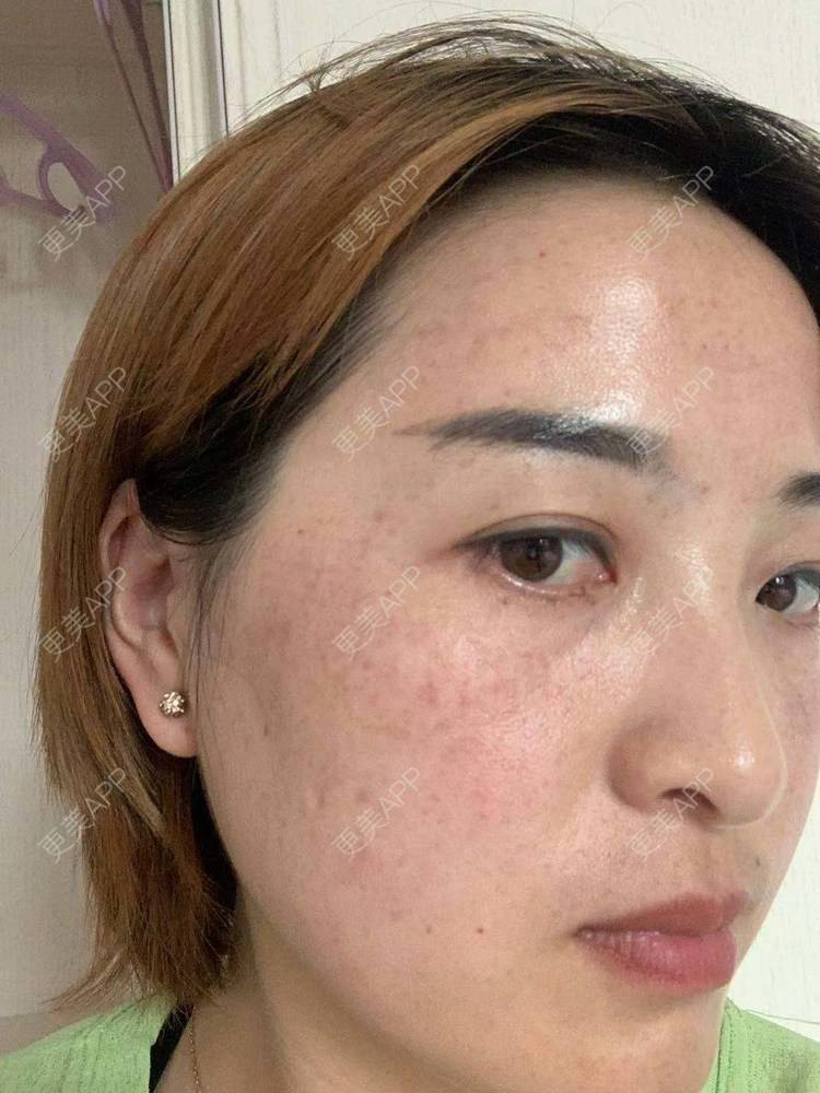 更美 - 更美用户QLfshUHHH0的注射美白经验 | 注射美白 | 淡斑套餐