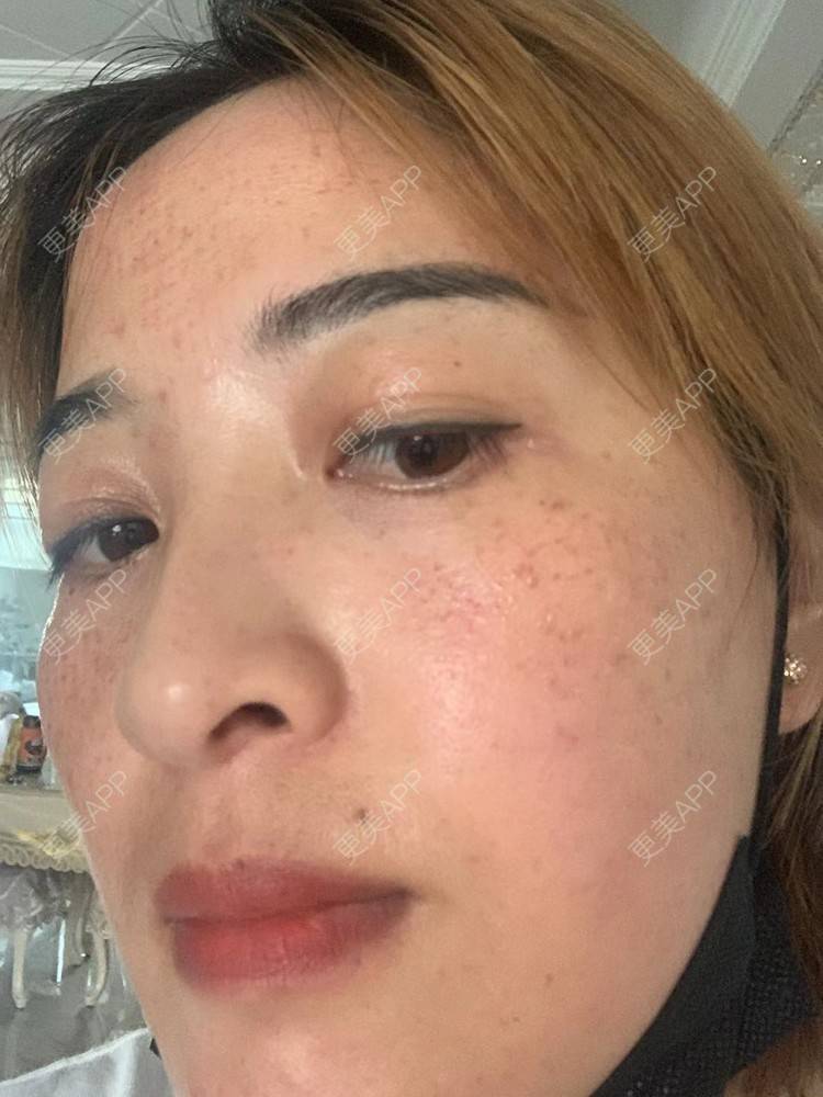 更美 - 更美用户QLfshUHHH0的注射美白经验 | 注射美白 | 淡斑套餐