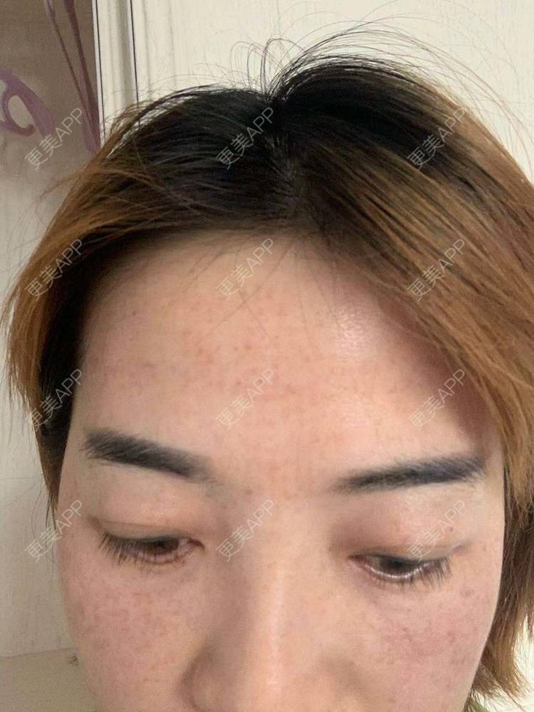 更美 - 更美用户QLfshUHHH0的注射美白经验 | 注射美白 | 淡斑套餐