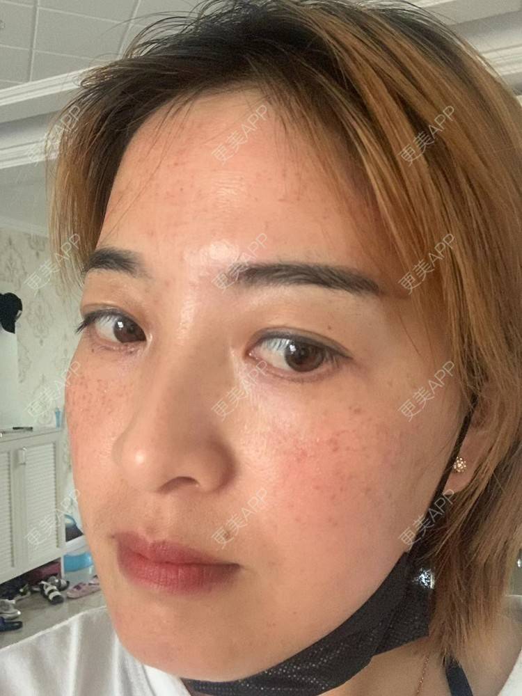 更美 - 更美用户QLfshUHHH0的注射美白经验 | 注射美白 | 淡斑套餐