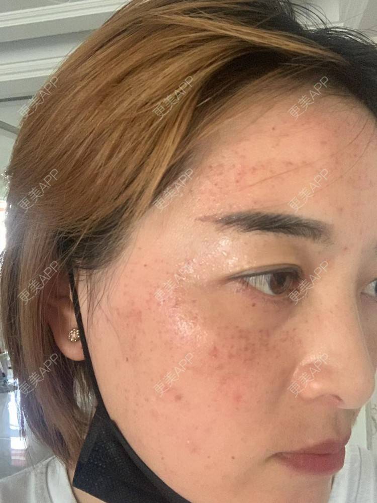 更美 - 更美用户QLfshUHHH0的注射美白经验 | 注射美白 | 淡斑套餐