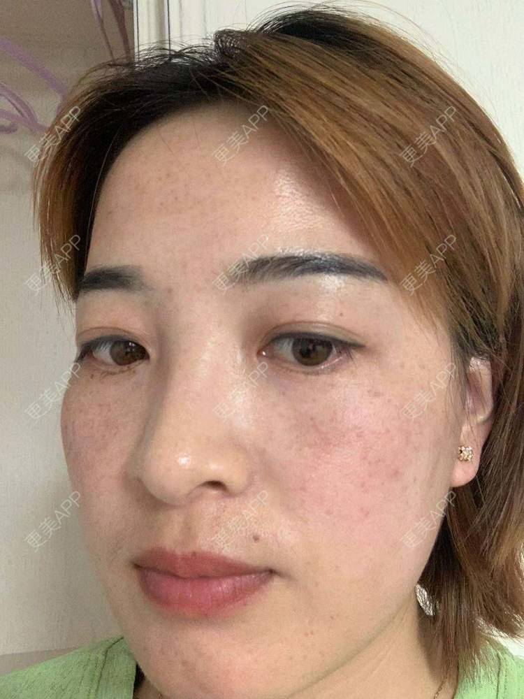 更美 - 更美用户QLfshUHHH0的注射美白经验 | 注射美白 | 淡斑套餐