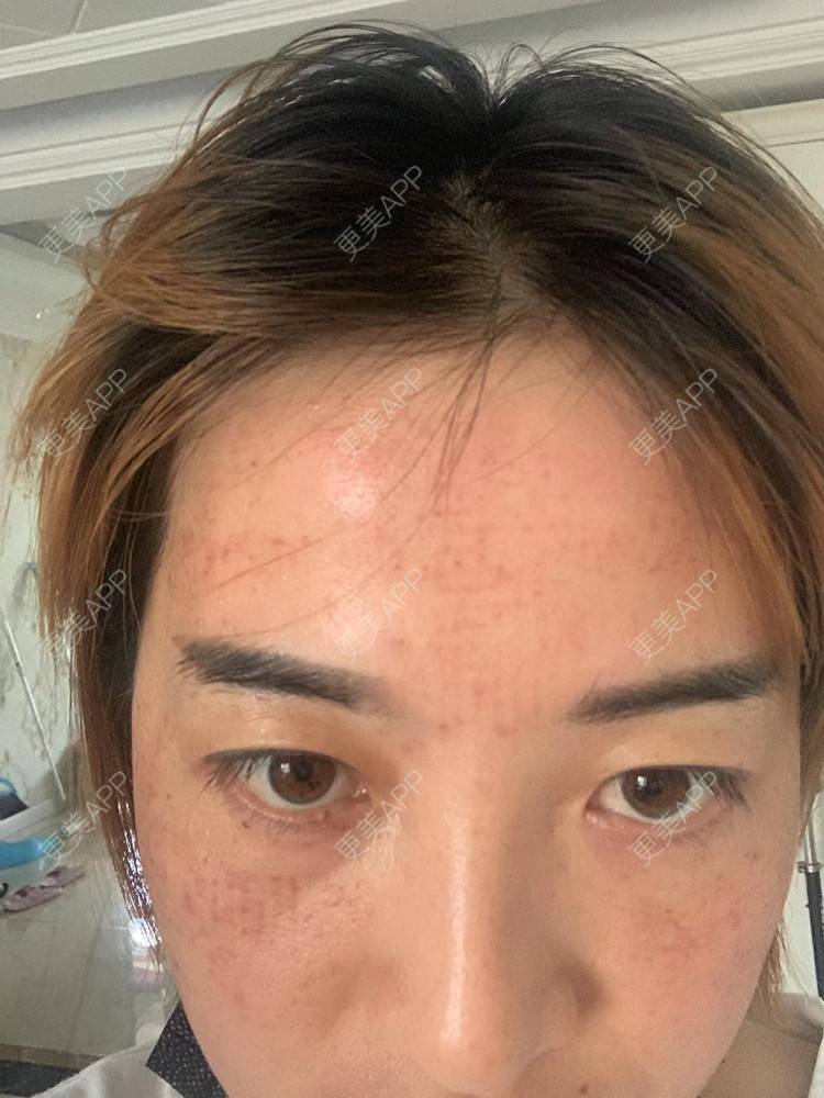 更美 - 更美用户QLfshUHHH0的注射美白经验 | 注射美白 | 淡斑套餐