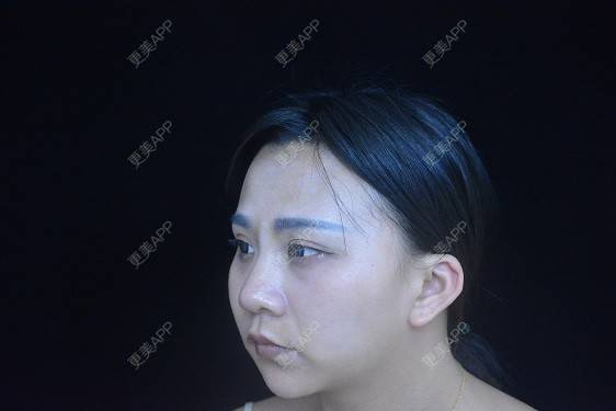 更美 - °·月亱相携林的除皱瘦脸经验 | 除皱瘦脸 | 玻尿酸面部细纹 | 玻尿酸唇部 | 北京