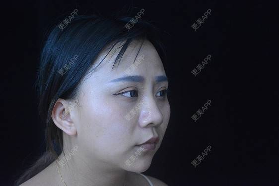 更美 - °·月亱相携林的除皱瘦脸经验 | 除皱瘦脸 | 玻尿酸面部细纹 | 玻尿酸唇部 | 北京