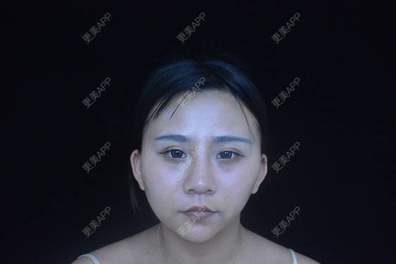 更美 - °·月亱相携林的除皱瘦脸经验 | 除皱瘦脸 | 玻尿酸面部细纹 | 玻尿酸唇部 | 北京