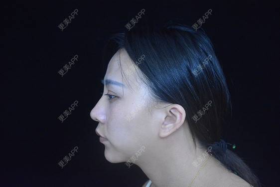 更美 - °·月亱相携林的除皱瘦脸经验 | 除皱瘦脸 | 玻尿酸面部细纹 | 玻尿酸唇部 | 北京
