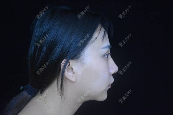 更美 - °·月亱相携林的除皱瘦脸经验 | 除皱瘦脸 | 玻尿酸面部细纹 | 玻尿酸唇部 | 北京