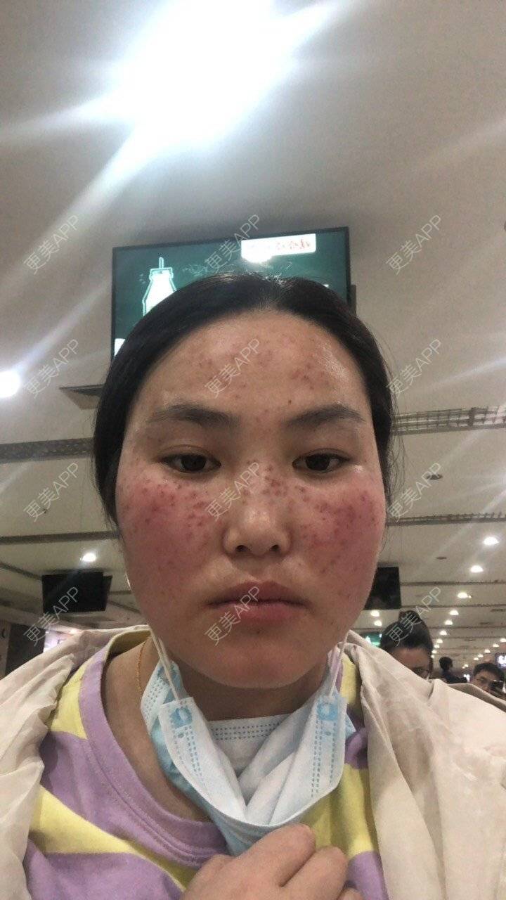 更美 - 水依人的皮秒激光经验 | 上海 | 皮秒激光