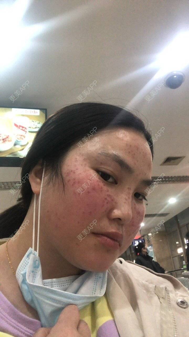 更美 - 水依人的皮秒激光经验 | 上海 | 皮秒激光