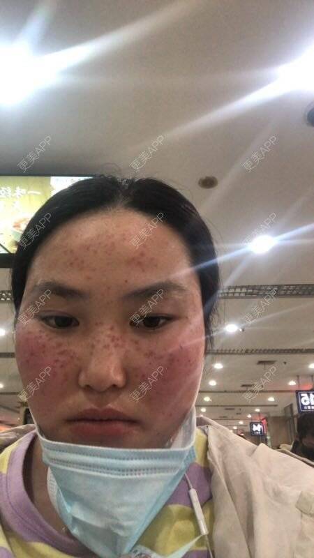 更美 - 水依人的皮秒激光经验 | 上海 | 皮秒激光