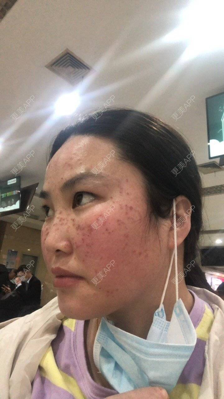 更美 - 水依人的皮秒激光经验 | 上海 | 皮秒激光