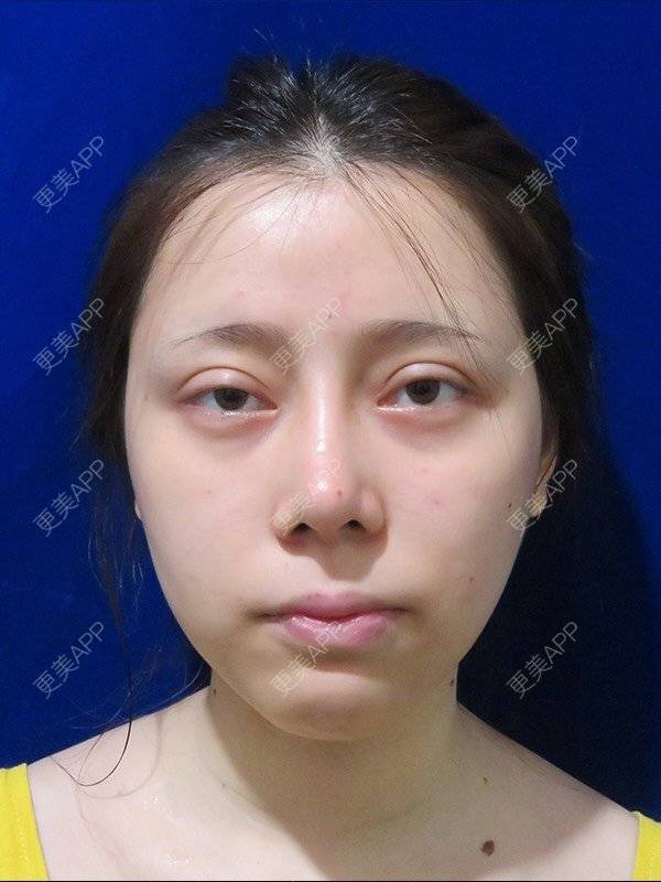 更美 - 更美用户dntqxTUqa7的全切双眼皮经验 | 全切双眼皮 | 开内眼角 | 开外眼角 | 自体脂肪淡化黑眼圈 | 福州