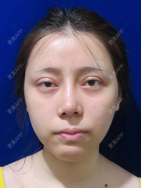 更美 - 更美用户dntqxTUqa7的全切双眼皮经验 | 全切双眼皮 | 开内眼角 | 开外眼角 | 自体脂肪淡化黑眼圈 | 福州