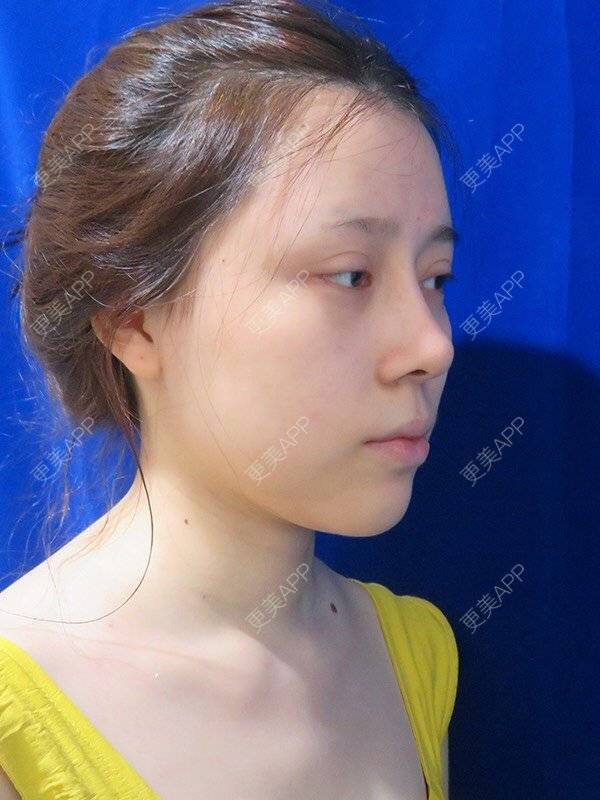 更美 - 更美用户dntqxTUqa7的全切双眼皮经验 | 全切双眼皮 | 开内眼角 | 开外眼角 | 自体脂肪淡化黑眼圈 | 福州