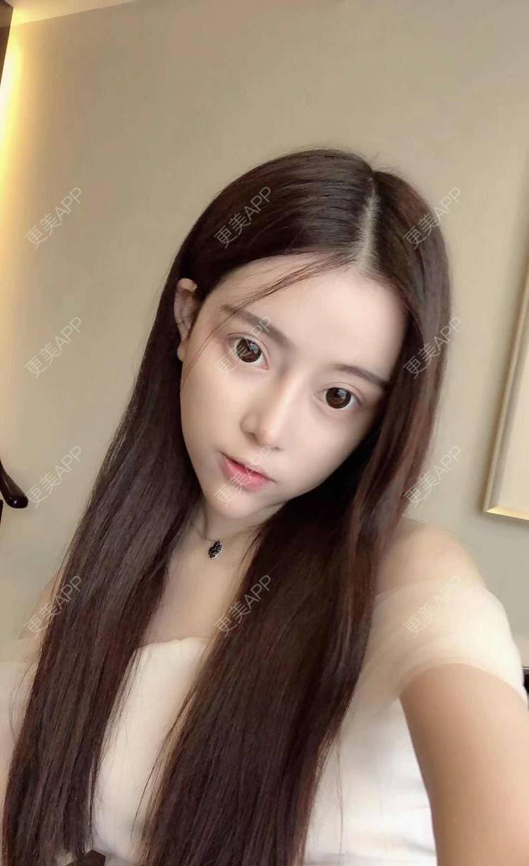 更美 - 更美用户dntqxTUqa7的全切双眼皮经验 | 全切双眼皮 | 开内眼角 | 开外眼角 | 自体脂肪淡化黑眼圈 | 福州