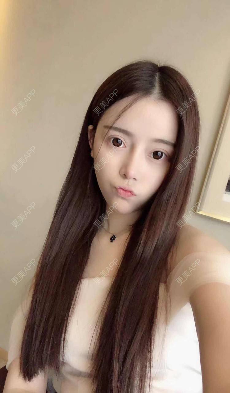 更美 - 更美用户dntqxTUqa7的全切双眼皮经验 | 全切双眼皮 | 开内眼角 | 开外眼角 | 自体脂肪淡化黑眼圈 | 福州