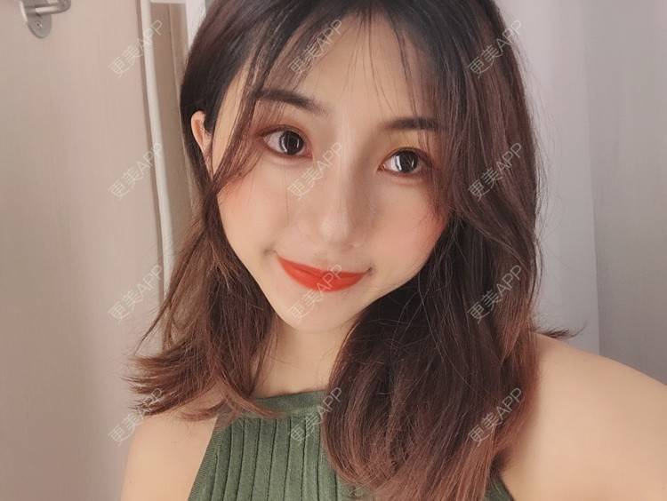 更美 - 更美用户h6811W70iO的鼻翼缩小经验 | 鼻翼缩小 | 人工骨隆鼻 | 真皮隆鼻 | 长鼻矫正 | 微晶瓷隆鼻 | 福州