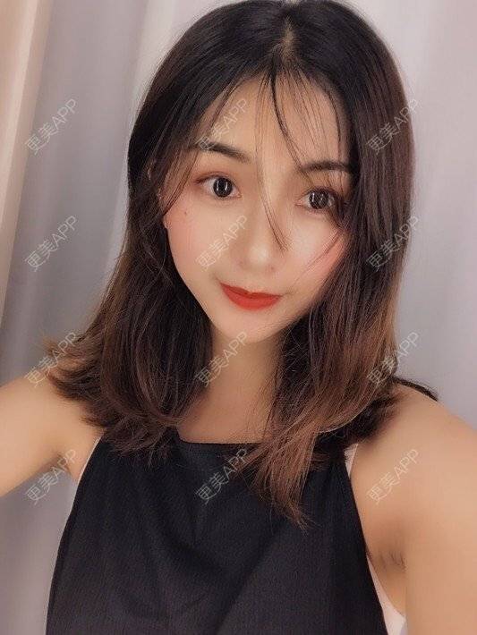 更美 - 更美用户h6811W70iO的鼻翼缩小经验 | 鼻翼缩小 | 人工骨隆鼻 | 真皮隆鼻 | 长鼻矫正 | 微晶瓷隆鼻 | 福州