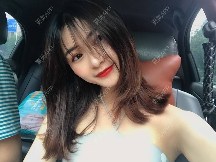更美 - 更美用户h6811W70iO的鼻翼缩小经验 | 鼻翼缩小 | 人工骨隆鼻 | 真皮隆鼻 | 长鼻矫正 | 微晶瓷隆鼻 | 福州