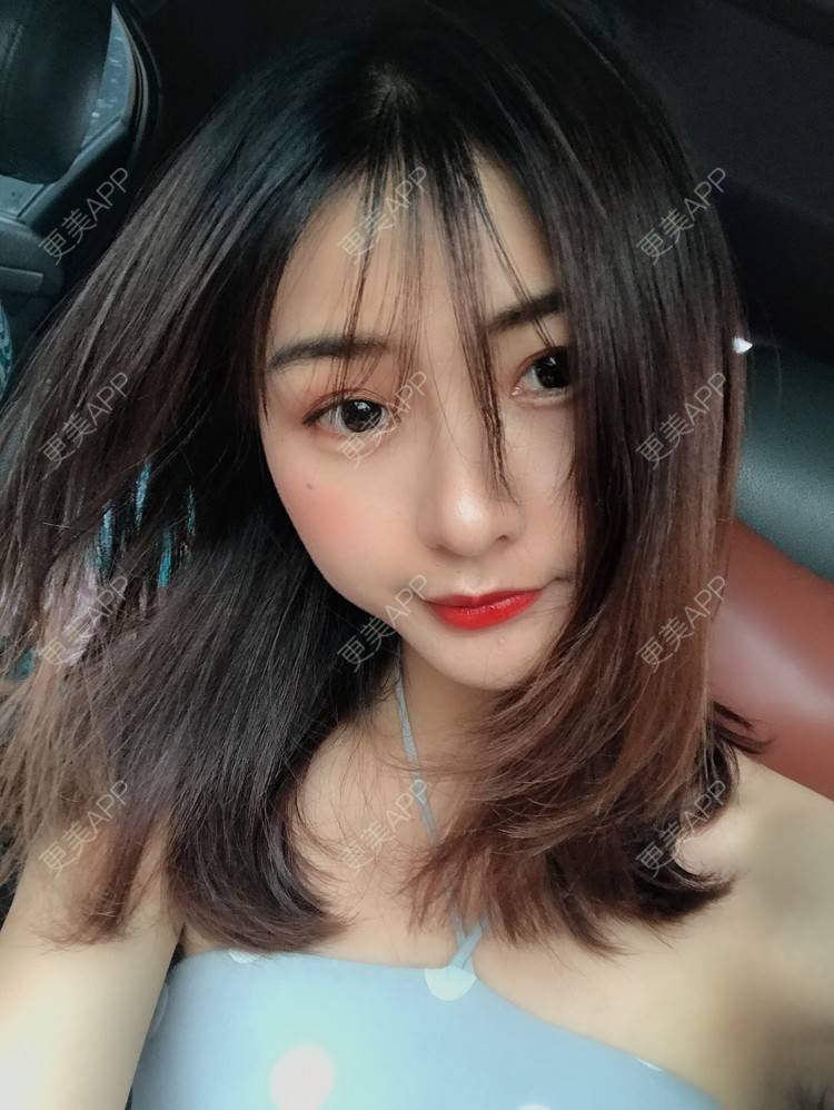 更美 - 更美用户h6811W70iO的鼻翼缩小经验 | 鼻翼缩小 | 人工骨隆鼻 | 真皮隆鼻 | 长鼻矫正 | 微晶瓷隆鼻 | 福州