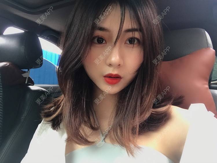 更美 - 更美用户h6811W70iO的鼻翼缩小经验 | 鼻翼缩小 | 人工骨隆鼻 | 真皮隆鼻 | 长鼻矫正 | 微晶瓷隆鼻 | 福州