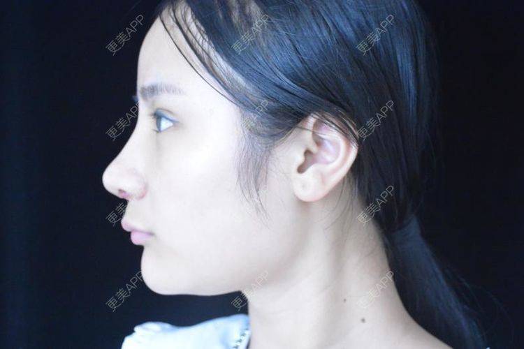 更美 - 江扳旧时月的洗眼线经验 | 皮秒激光 | 激光淡斑 | 洗眼线 | 北京