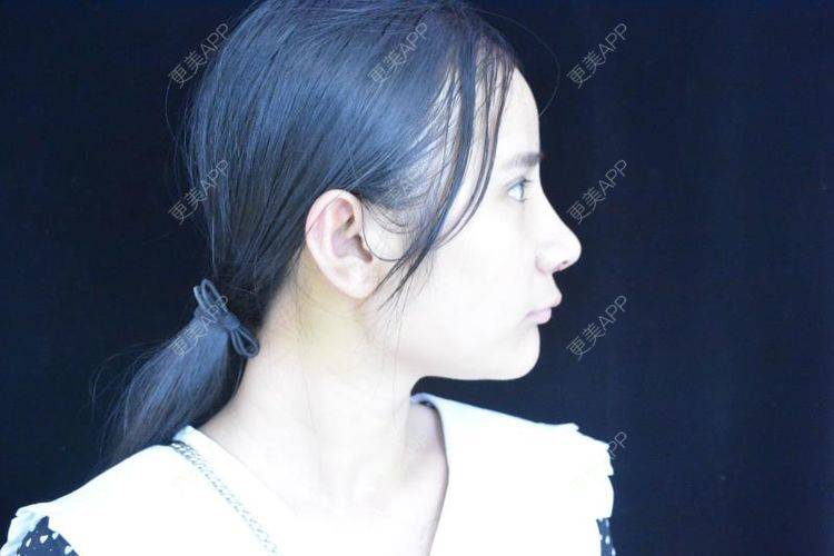 更美 - 江扳旧时月的洗眼线经验 | 皮秒激光 | 激光淡斑 | 洗眼线 | 北京