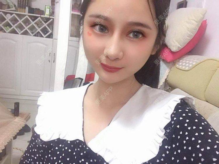 更美 - 江扳旧时月的洗眼线经验 | 北京 | 激光淡斑 | 皮秒激光 | 洗眼线