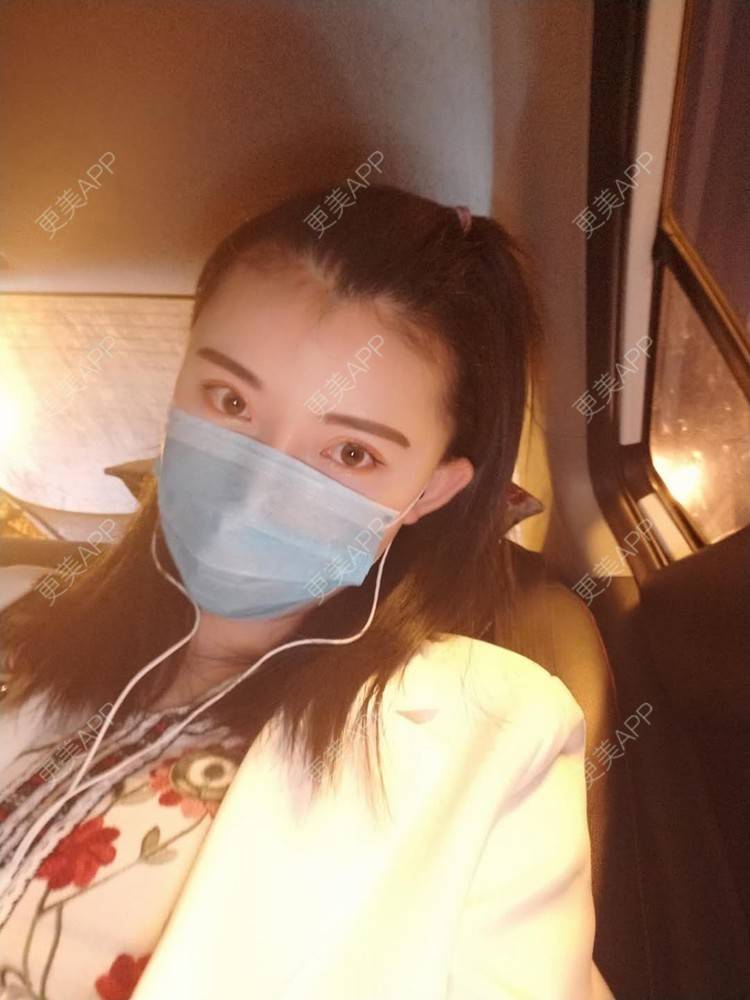 更美 - 璀璨太阳花骨朵的双眼皮修复经验 | 全切双眼皮 | 合肥 | 双眼皮修复 | 上眼睑去脂 | 开眼角修复