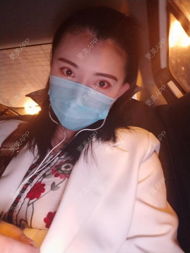 更美 - 璀璨太阳花骨朵的双眼皮修复经验 | 全切双眼皮 | 合肥 | 双眼皮修复 | 上眼睑去脂 | 开眼角修复