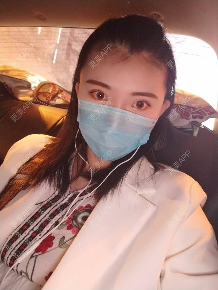 更美 - 璀璨太阳花骨朵的双眼皮修复经验 | 全切双眼皮 | 合肥 | 双眼皮修复 | 上眼睑去脂 | 开眼角修复