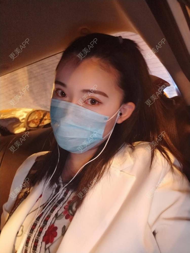 更美 - 璀璨太阳花骨朵的双眼皮修复经验 | 全切双眼皮 | 合肥 | 双眼皮修复 | 上眼睑去脂 | 开眼角修复