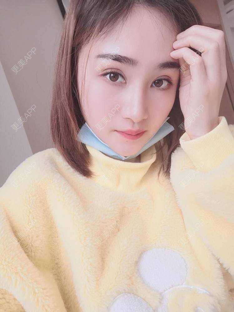 更美 - 小熊饼最爱的双眼皮修复经验 | 重庆 | 双眼皮修复