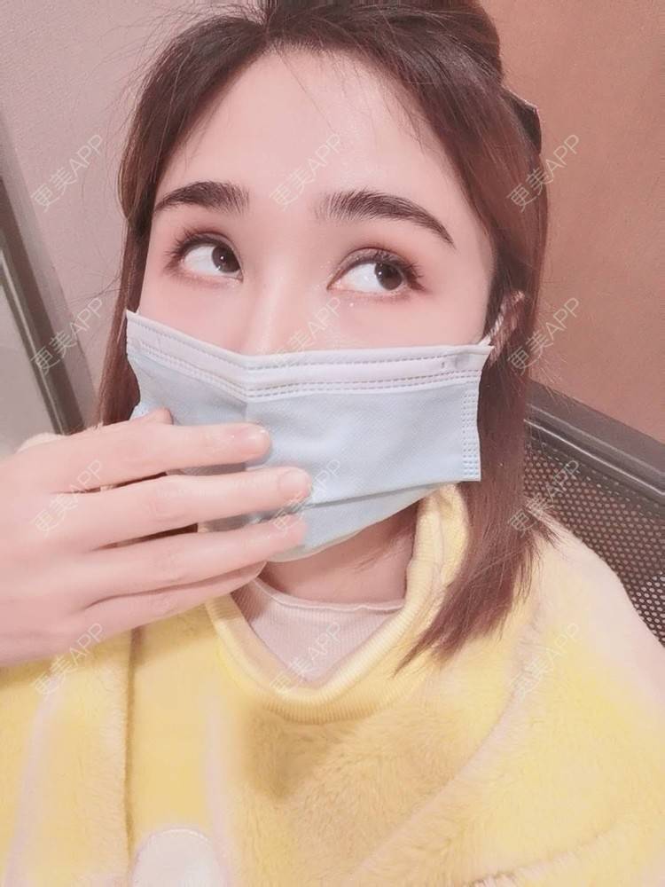 更美 - 小熊饼最爱的双眼皮修复经验 | 重庆 | 双眼皮修复