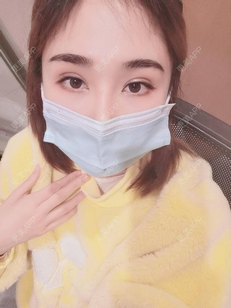 更美 - 小熊饼最爱的双眼皮修复经验 | 重庆 | 双眼皮修复