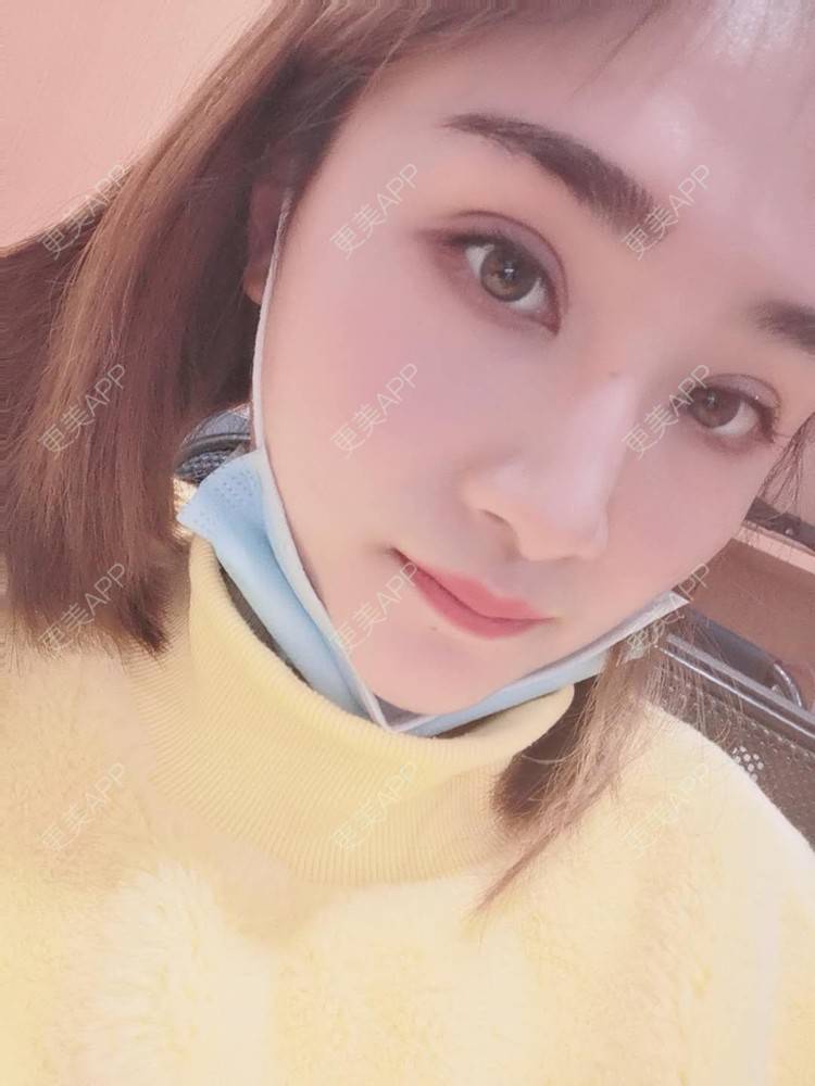 更美 - 小熊饼最爱的双眼皮修复经验 | 重庆 | 双眼皮修复