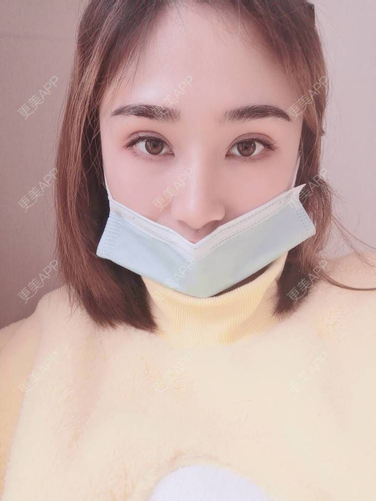 更美 - 小熊饼最爱的双眼皮修复经验 | 重庆 | 双眼皮修复