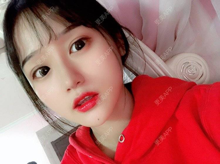 更美 - 更美用户DA866o9TYE的驼峰鼻矫正经验 | 驼峰鼻矫正 | 鼻翼缩小 | 人工骨隆鼻 | 真皮隆鼻 | 长鼻矫正 | 福州