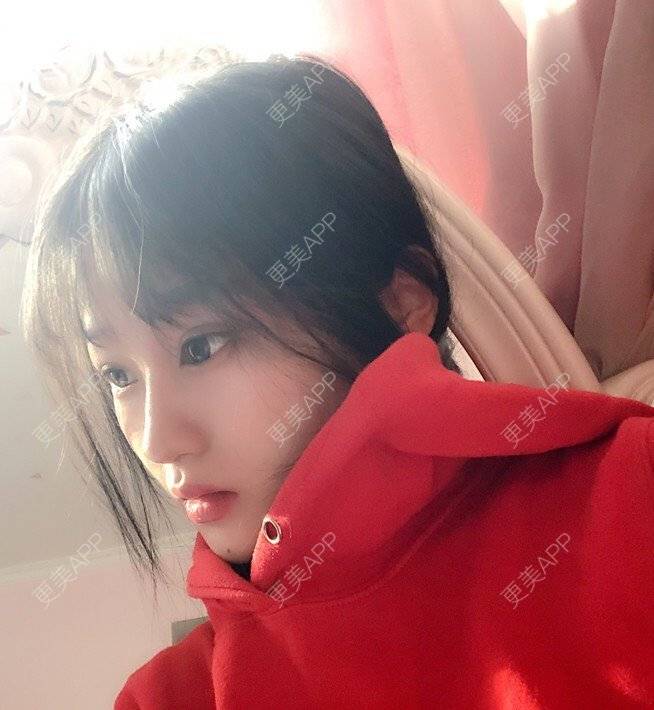 更美 - 更美用户DA866o9TYE的驼峰鼻矫正经验 | 驼峰鼻矫正 | 鼻翼缩小 | 人工骨隆鼻 | 真皮隆鼻 | 长鼻矫正 | 福州