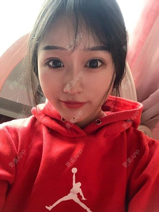 更美 - 更美用户DA866o9TYE的驼峰鼻矫正经验 | 驼峰鼻矫正 | 鼻翼缩小 | 人工骨隆鼻 | 真皮隆鼻 | 长鼻矫正 | 福州