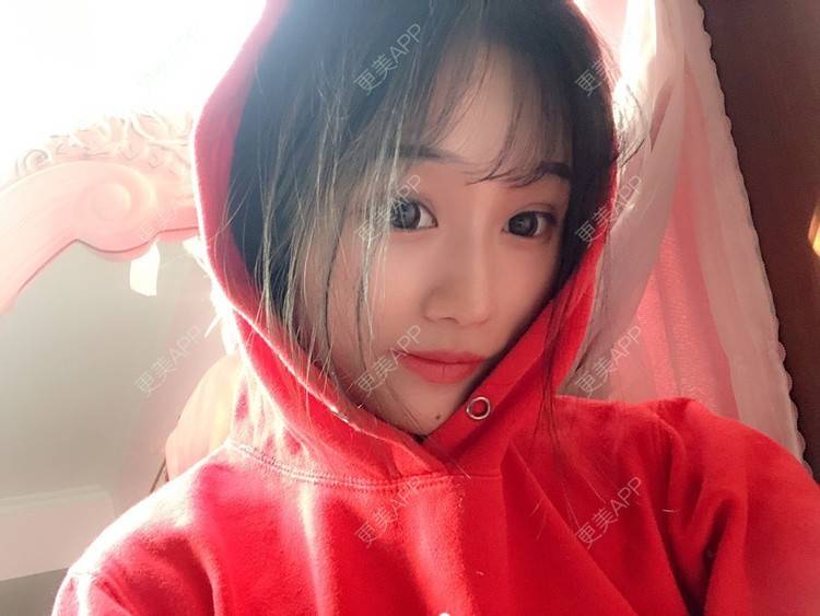 更美 - 更美用户DA866o9TYE的驼峰鼻矫正经验 | 驼峰鼻矫正 | 鼻翼缩小 | 人工骨隆鼻 | 真皮隆鼻 | 长鼻矫正 | 福州