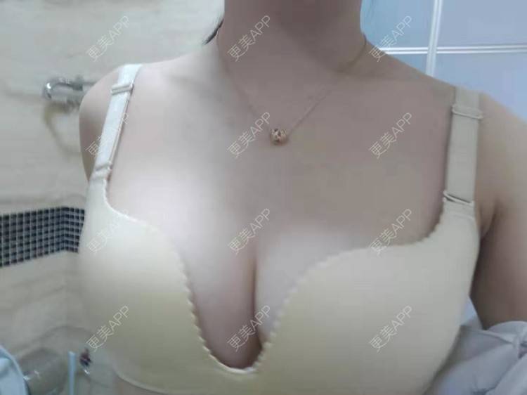 更美 - 辣辣的辣辣的假体隆胸经验 | 视频日记 | 杭州 | 假体隆胸 | 更美研究所