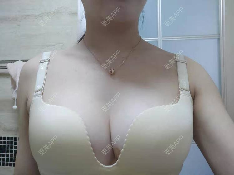 更美 - 辣辣的辣辣的假体隆胸经验 | 视频日记 | 杭州 | 假体隆胸 | 更美研究所