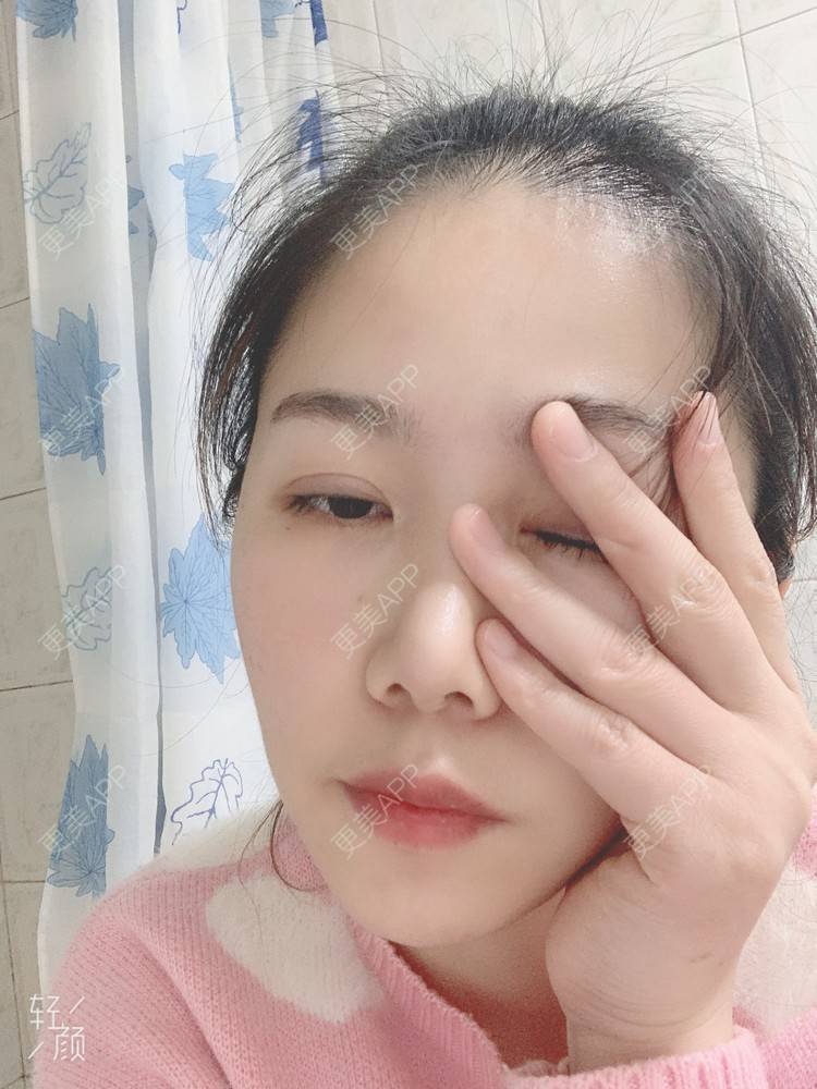 更美 - 浃浃！的厚唇改薄经验 | 厚唇改薄 | 上海