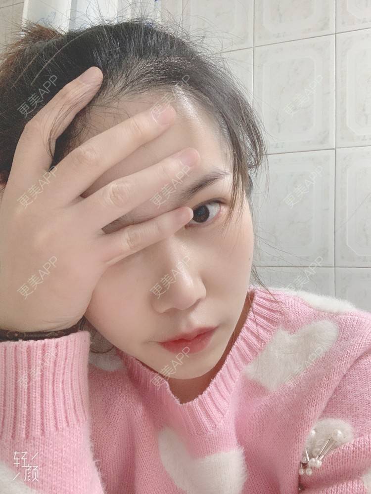 更美 - 浃浃！的厚唇改薄经验 | 厚唇改薄 | 上海