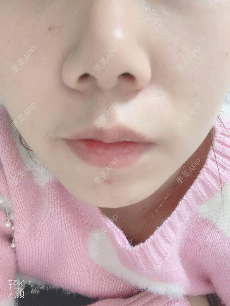 更美 - 浃浃！的厚唇改薄经验 | 厚唇改薄 | 上海