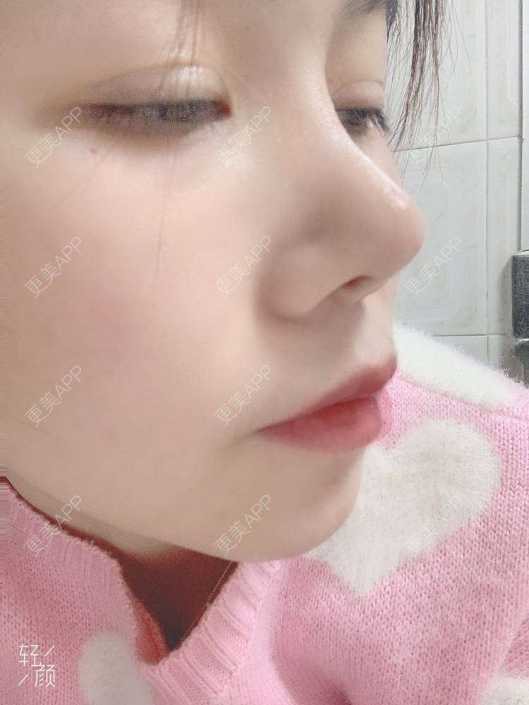 更美 - 浃浃！的厚唇改薄经验 | 厚唇改薄 | 上海